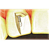 Op Po Precious Posts Grey 1.0mm 10/pk Pack